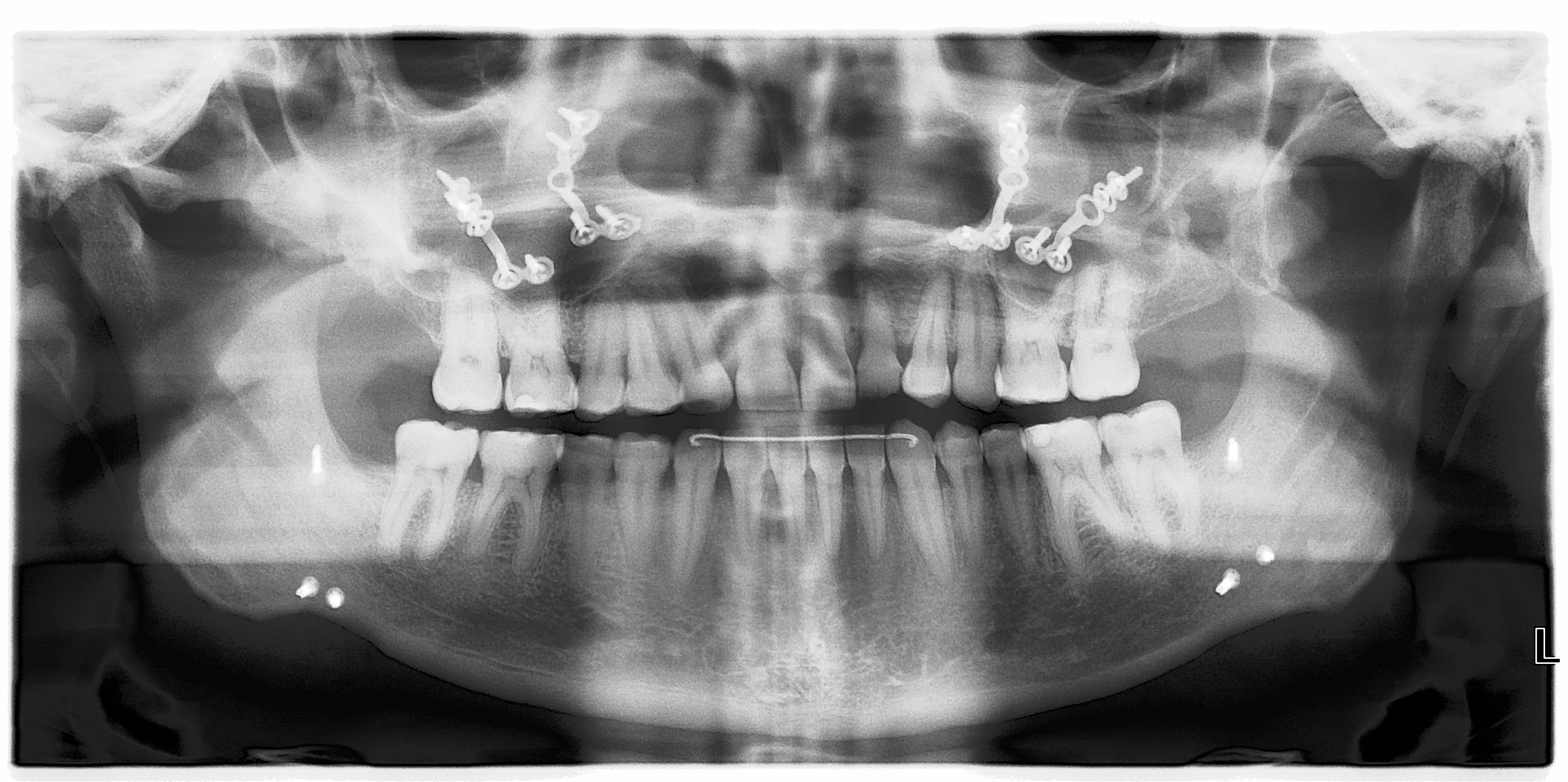 X-ray taken 20 years after my orthognathic surgery, showing surgical plates and screws